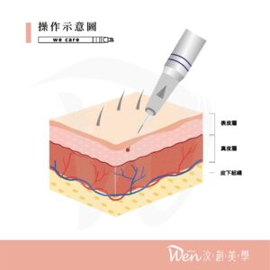 高雄霧眉操作示意圖