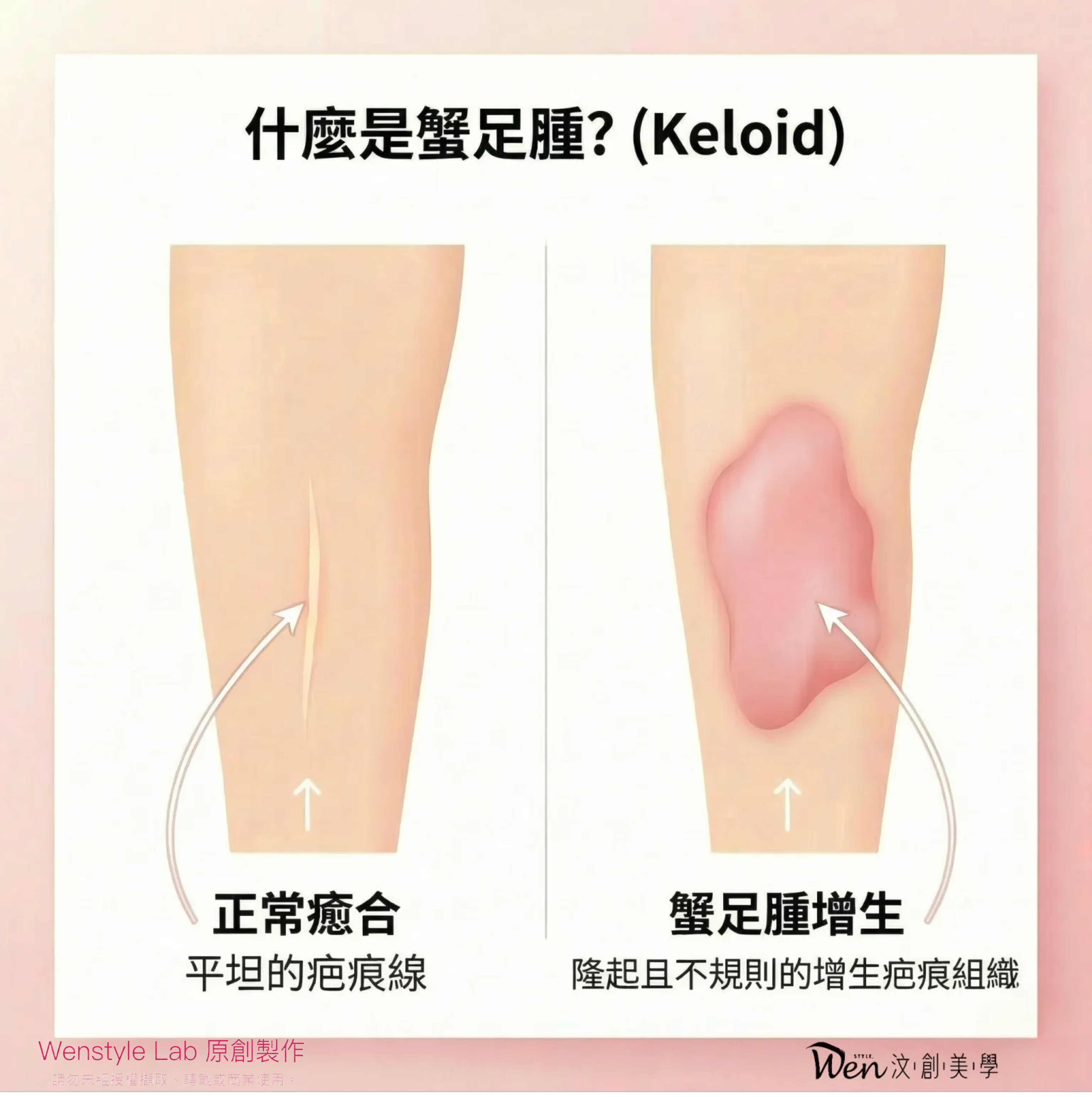 什麼是蟹足腫